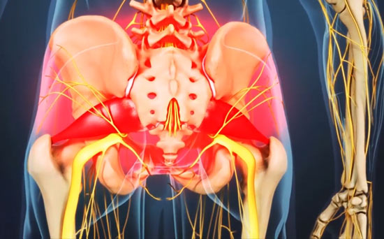 A pyriformis alagút syndroma okai szerteágazóak A pyriformis alagút syndroma okai szerteágazóak